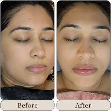 Carbon Facial Glow