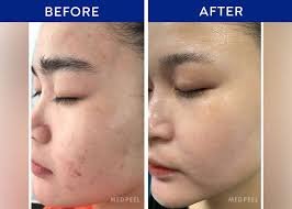 Chemical Peeling After