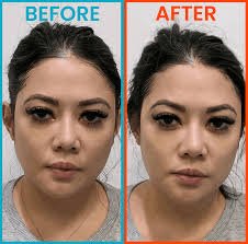 HIFU Skin Tightening