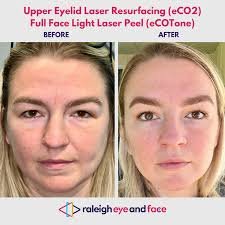 CO2 Fractional Skin Renewal