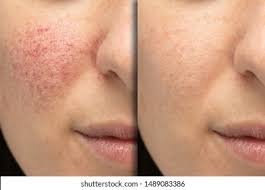 Laser Toning After