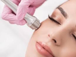 Microdermabrasion Treatment Before