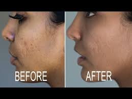 Microdermabrasion After