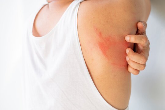 Dandruff Treatment