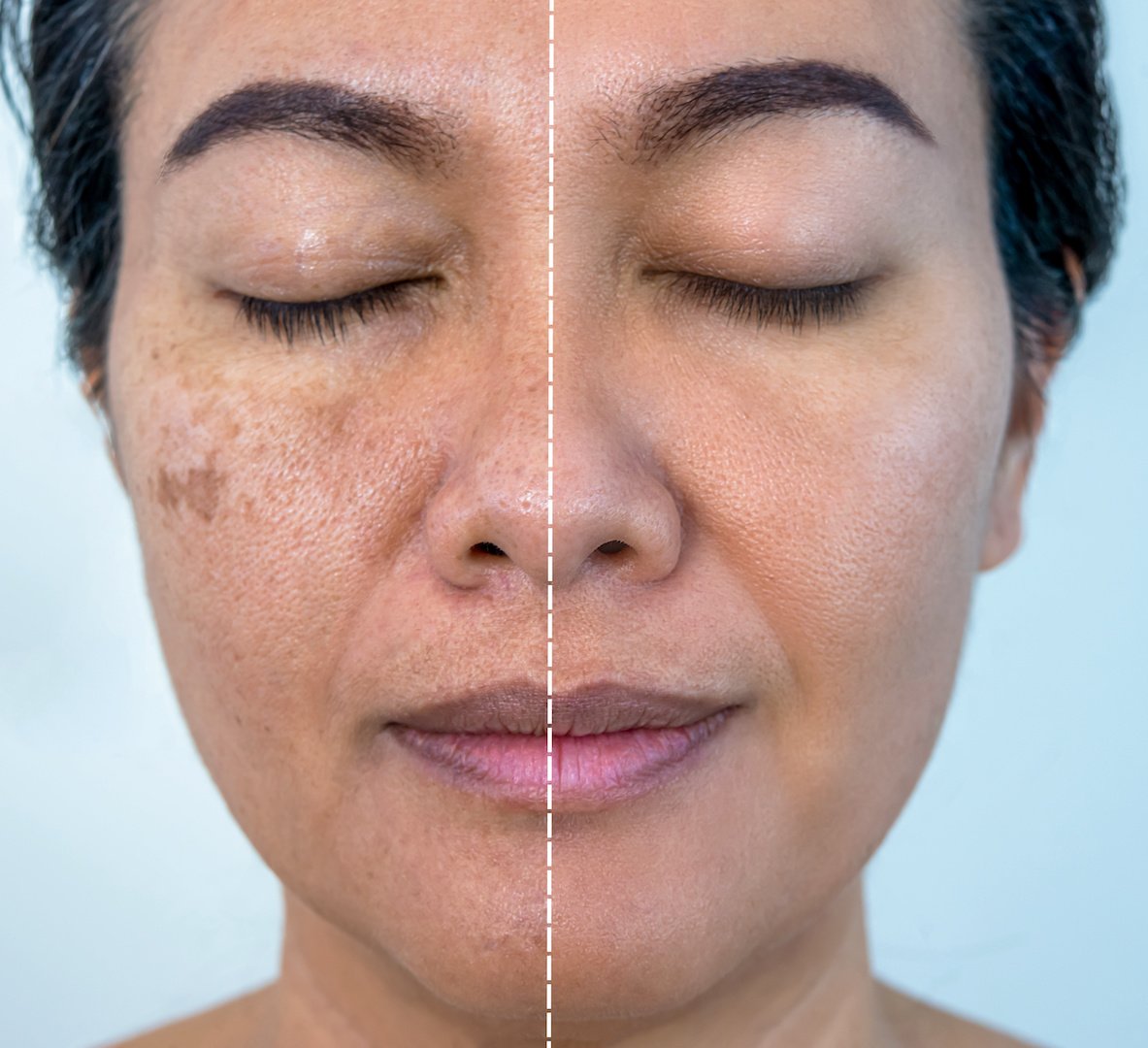 Alopecia Treatment