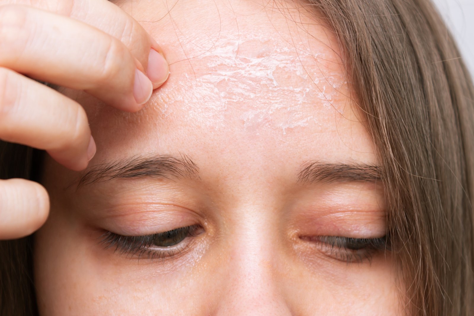 Dandruff Treatment